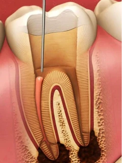Эндодонтическое лечение пульпита