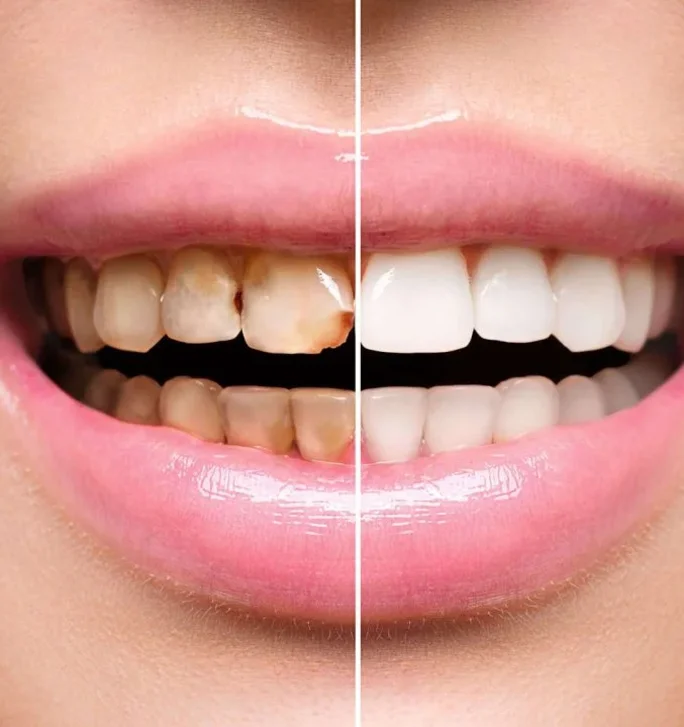 Реставрация зуба композитным материалом