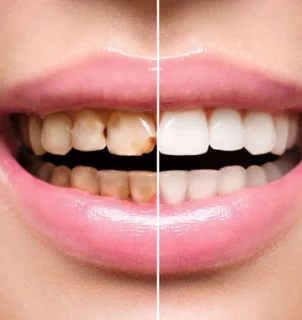 Фото для Реставрация зуба композитным материалом