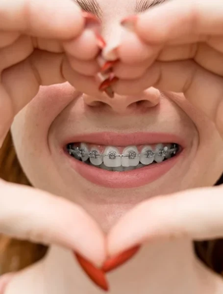 Фото для Установка брекет - систем Mini Diamond