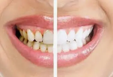 Профессиональная гигиена полости рта и зубов по технологии Air-Flow