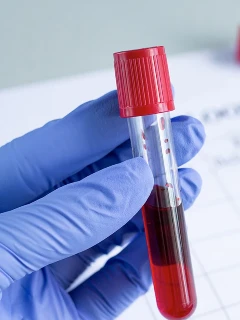 Обмен железа 3 параметра, насыщение трансферина железом