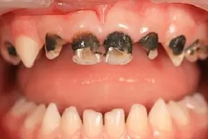 Лечение молочных зубов деткам от 1 года 
